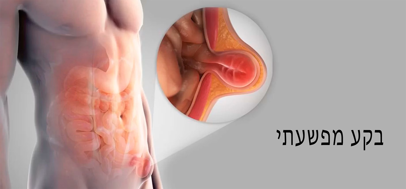 دعوى للاعتراف بفتق الرياضيين كإصابة عمل